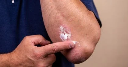 Difference Between Ayurvedic and Modern Treatment for Skin Diseases